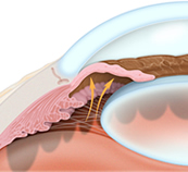 Glaucoma Treatment | Lasik Surgery | Ardmore OK | Lone Grove OK