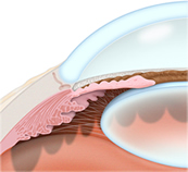 Glaucoma Treatment | Lasik Surgery | Ardmore OK | Lone Grove OK